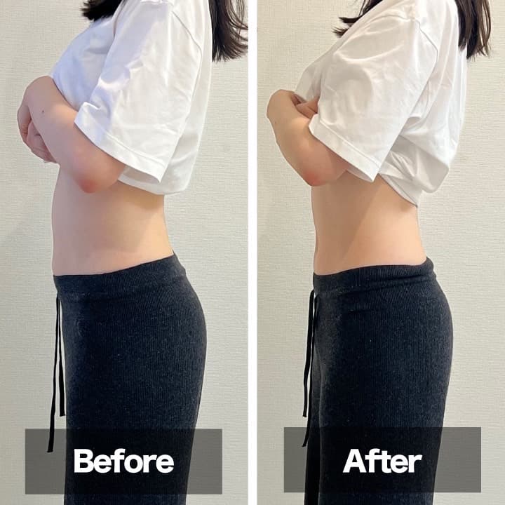 施術前後の比較。ぽっこりお腹からスッキリしたラインへ、ウエスト約4cmの変化。